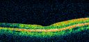 ocularischemiacarotids_chbl21.jpg