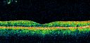ocularischemiacarotids_chbl22.jpg