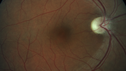 optic-atrophy-MS_jamor_051719_01.png