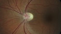 optic-atrophy-MS_jamor_051719_04.png