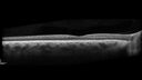 optic-atrophy-MS_jamor_051719_06.jpg