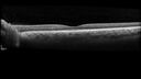 optic-atrophy-MS_jamor_051719_07.jpg