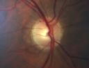 opticatrophypittumor_cost01.jpg
