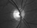 opticatrophypittumor_cost03.jpg