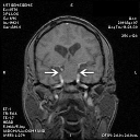 opticatrophypittumor_cost06.png