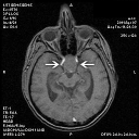 opticatrophypittumor_cost07.png