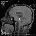 opticatrophypittumor_cost08.png