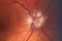 opticnervehypoplasia_jofo01.jpg