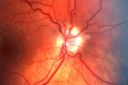 opticnervehypoplasia_jofo02.jpg