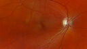 opticneuritis_124345_031725_01.jpg