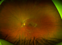 osteoma_28329.PNG