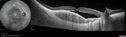 osteoma_28429.jpg