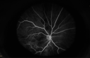 osteoma_28529.PNG