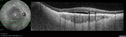 osteoma_28629.jpg