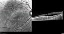 osteoma_OD_anw_103117_007001.jpg
