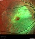 osteoma_OD_anw_103117_008.jpg