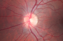 outeretinalhole_cach1_012915_06.png