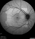 outeretinalhole_cach1_012915_11.jpg