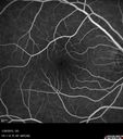 outeretinalhole_cach1_012915_20.jpg
