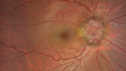 papilledema1_daked_121619_01.png