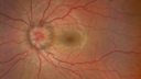 papilledema1_daked_121619_02.png