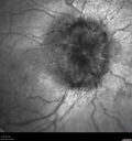 papilledema1_daked_121619_03.jpg