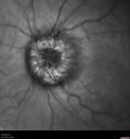 papilledema1_daked_121619_04.jpg