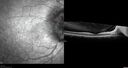 papilledema1_daked_121619_05.jpg