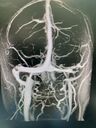 papilledema1_daked_121619_16.jpg