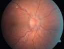 papilledema_JADU_052813_01.jpg
