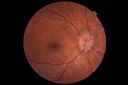 papilledema_dafer_010719_01.JPG