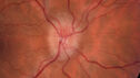 papilledema_dafer_010719_02.JPG
