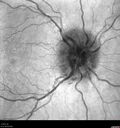 papilledema_dafer_010719_05.jpg