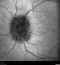 papilledema_dafer_010719_06.jpg