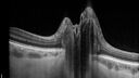 papilledema_dafer_010719_08.jpg