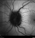 papilledema_dafer_010719_14.jpg