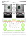 papilledema_dafer_010719_15.JPG