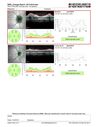 papilledema_dafer_010719_17.JPG