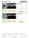 papilledema_dafer_010719_18.JPG