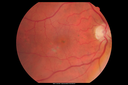 patterndys_husmi_021816_01.png