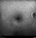 patterndys_husmi_021816_09.jpg