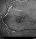 patterndys_husmi_021816_11.jpg