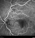 patterndys_husmi_021816_13.jpg