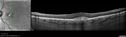 patterndystrophy-nasalmacula-lisc-111717_281129.jpg