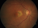 patterndystrophy-nasalmacula-lisc-111717_28129.png