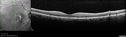 patterndystrophy-nasalmacula-lisc-111717_28229.jpg