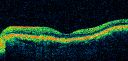 patterndystrophy_jowa06.jpg