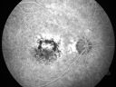 patterndystrophy_jowa11.jpg