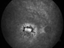 patterndystrophy_jowa14.jpg