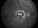patterndystrophy_jowa15.jpg